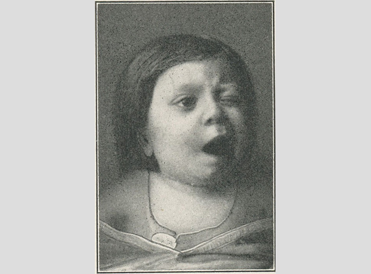 polio