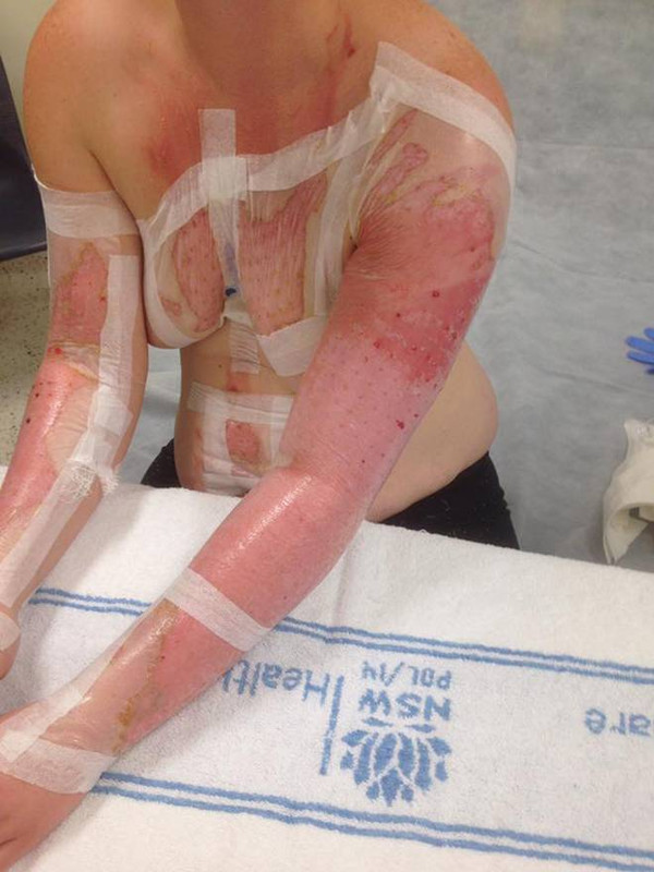 instant cooker burns