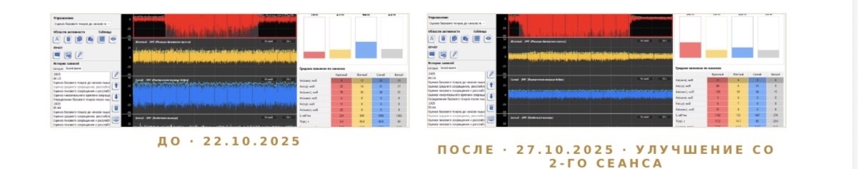 Кейс 3 — ЭМГ до и после БОС-терапии