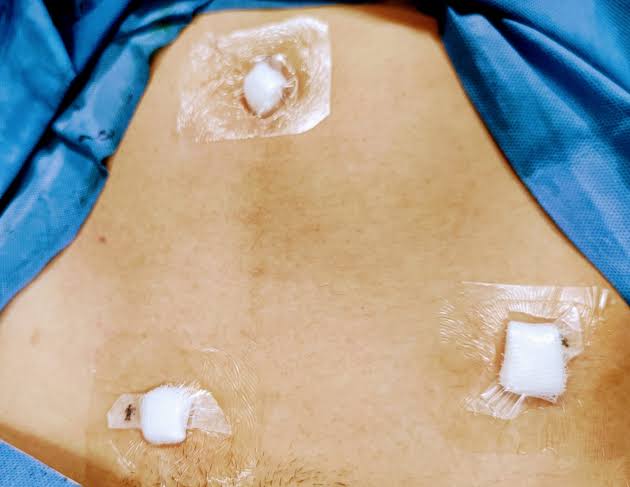 Guía de Recuperación Postoperatoria para una Apendicectomía Laparoscópica
