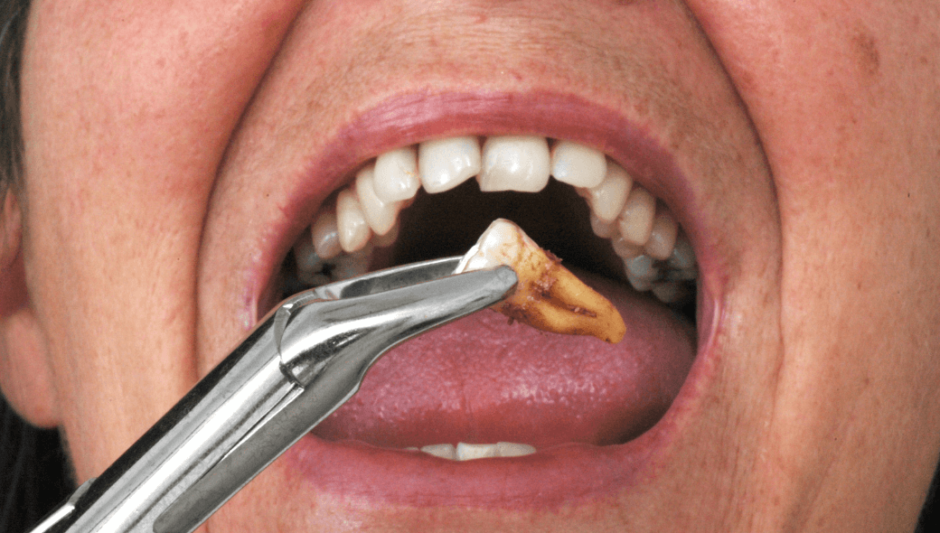 Tooth Extraction