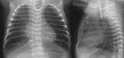 Chest/abdominal radiograph: coiled nasogastric tube in proximal esophageal pouch, air-distended stomach and bowel loops indicating distal TEF