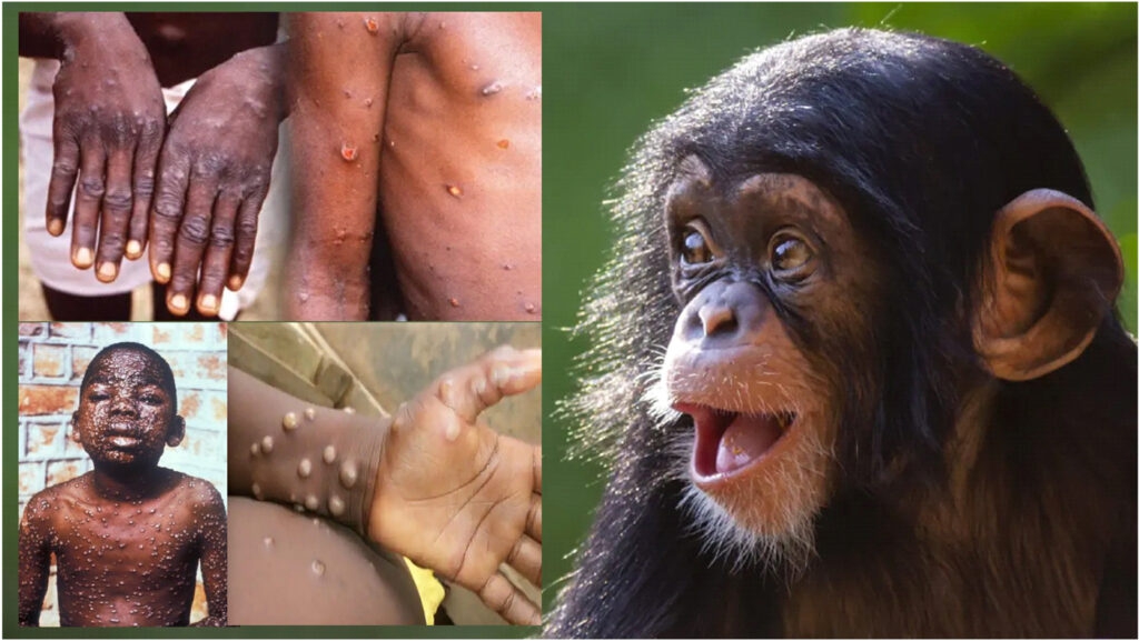 Brote de viruela del mono estaría vinculado a un evento en sauna de España