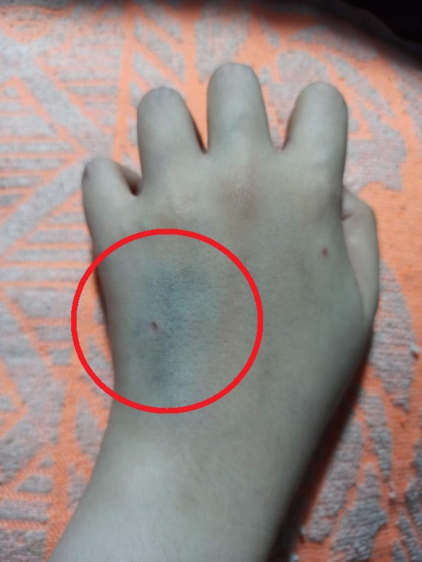 tangan lebam setelah kemoterapi