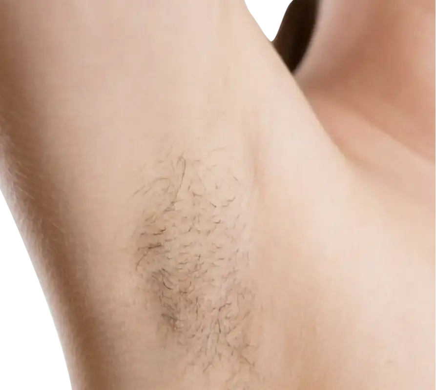 Best Laser Hair Removal In Bangladesh 2 Before Best Laser Hair Removal Dhaka at Vita Skin
