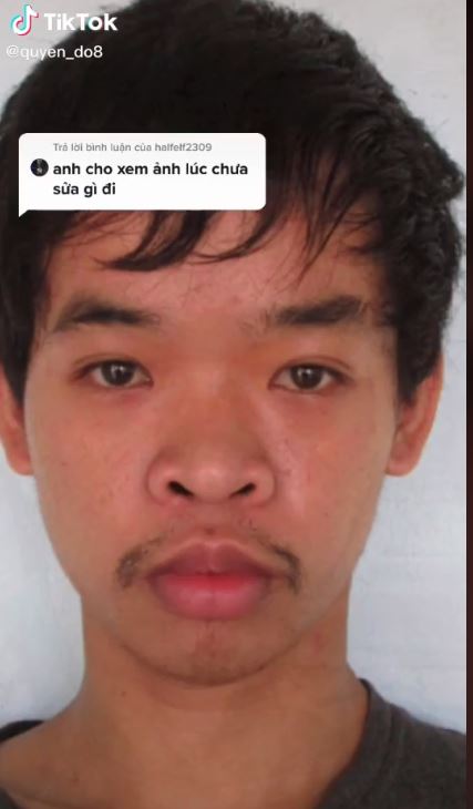 Do Quyen sebelum operasi plastik