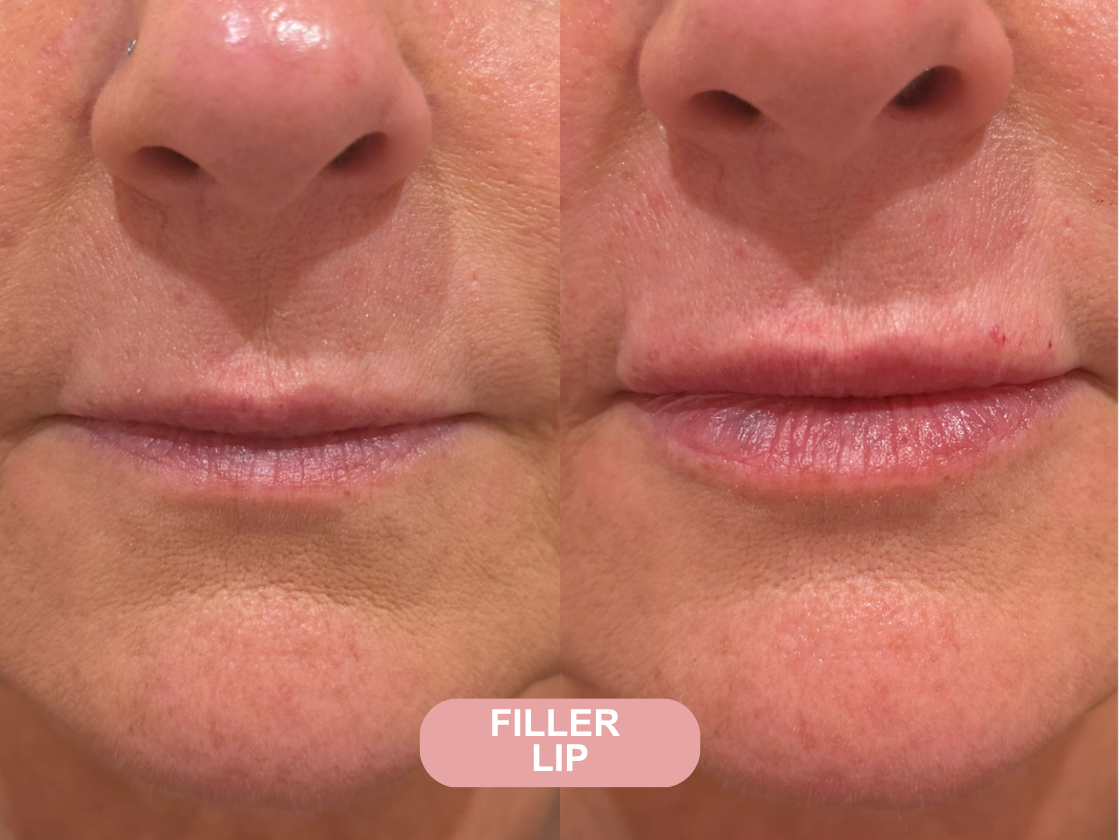 Neuromodulator before and after results at Let's Face It Med Spa