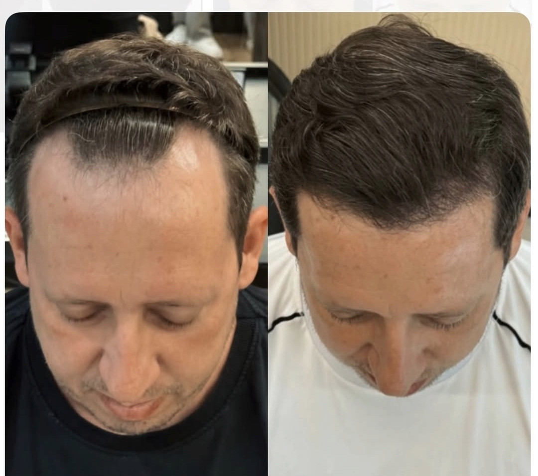 Resultado de transplante capilar 2