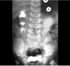 IVU showing duplicated ureter (duplex collecting system) with upper pole moiety