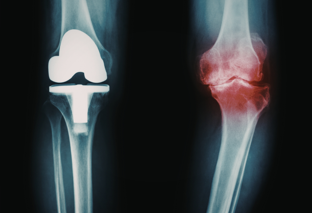 Artrosis y desgaste articular