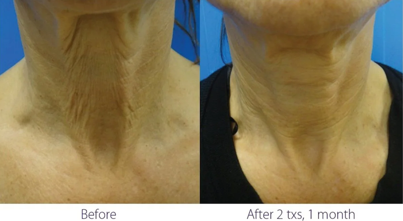 ClearLift before and after result at Let's Face It Med Spa in Denver.