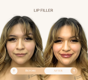 Lip filler before and after result