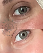 Eyenex Result 2