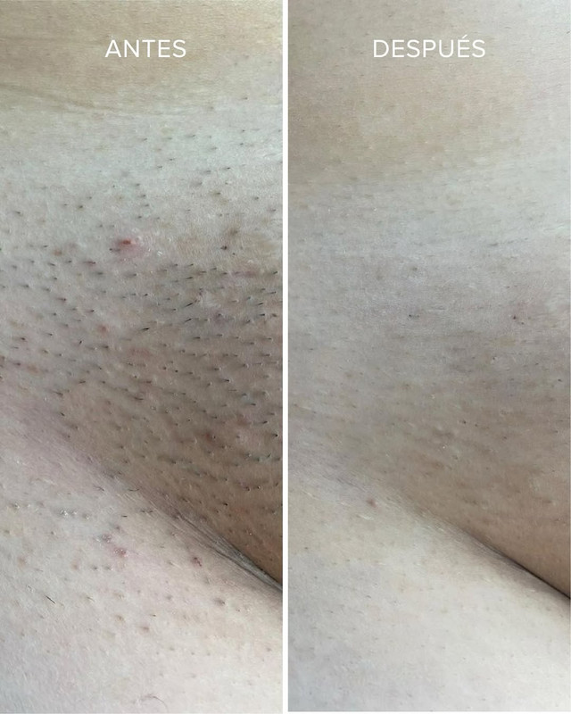 Antes / Después