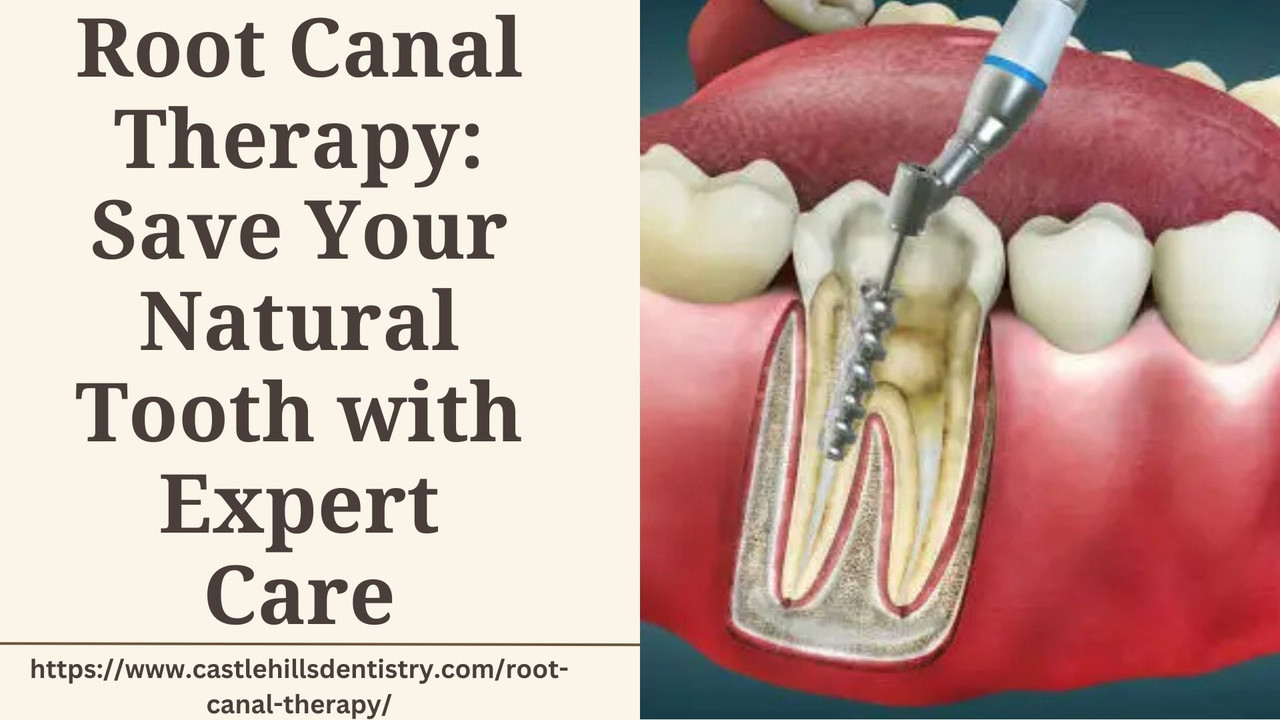 Root Canal Therapy (1)