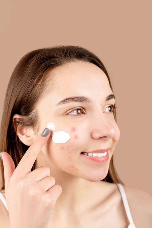 a young woman applyingacne treatment on her acne-prone skin 