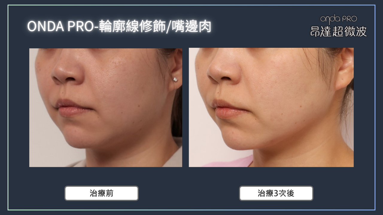 昂達超微波案例：輪廓線