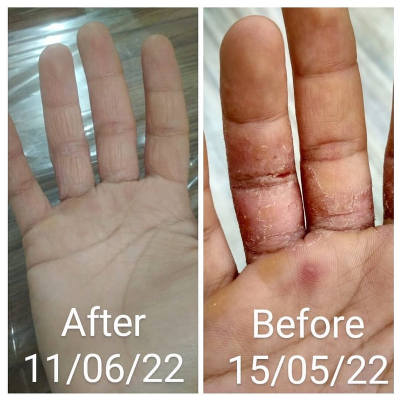 Chronic skin condition treatment before and after