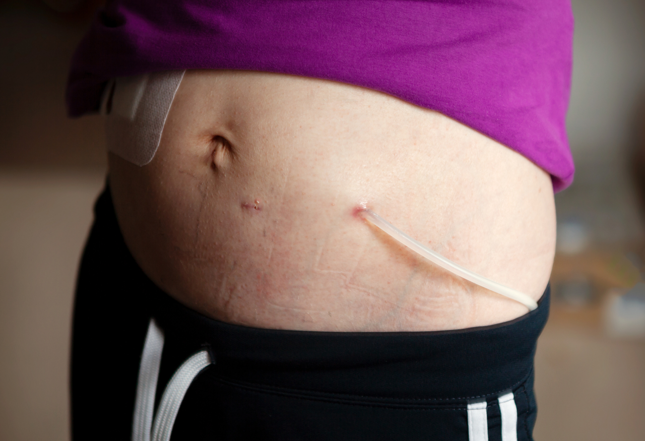 Diálisis peritoneal