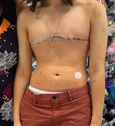 breast removal 3