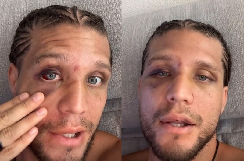 Брайън Ортега показа пораженията след UFC 306