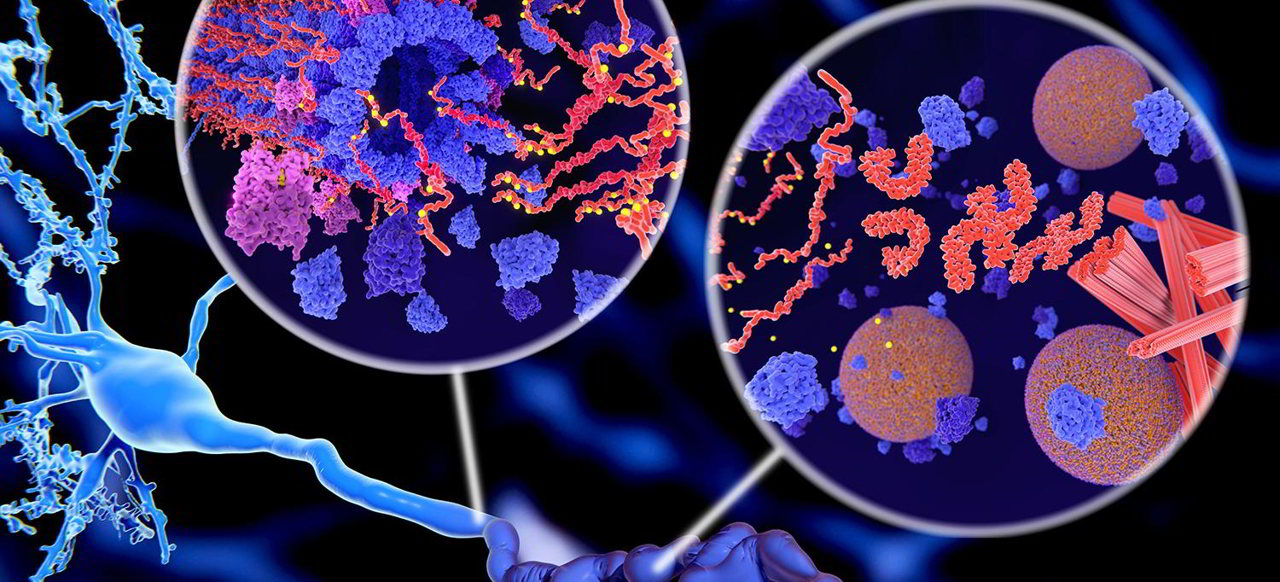 Alzheimer: Cosa causa la rapida morte delle cellule cerebrali e la demenza