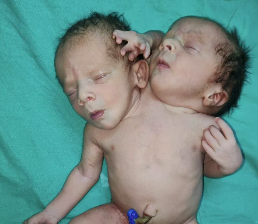 Nace bebé con dos cabezas y tres manos en India; madre creyó que tendría mellizos