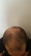 Injerto de pelo, RESULTADO INCREIBLE