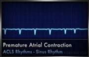 premature atrial contraction