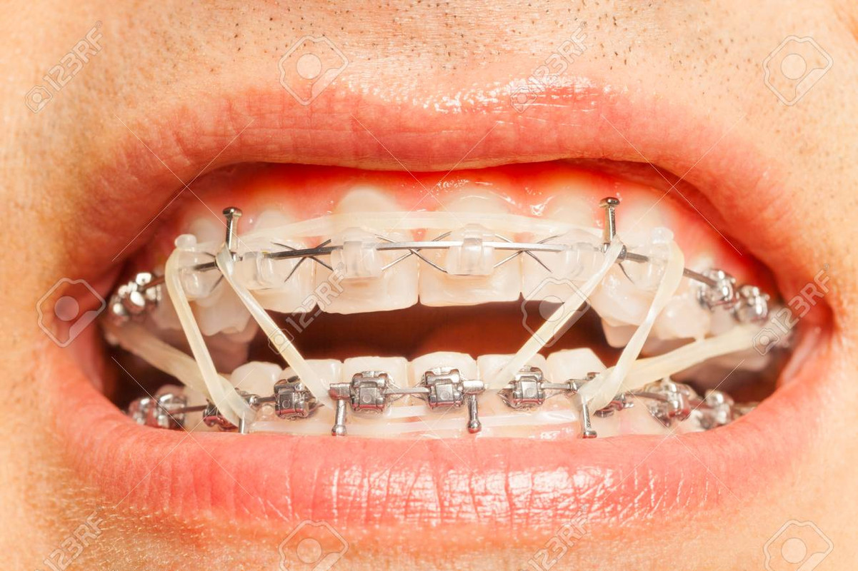 74607421-aparatos-dentales-con-anillos-de-corrección-de-ortodonc