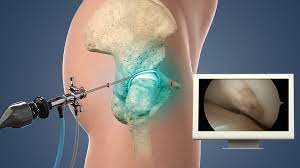 Hip Arthroscopy-Diagnosis, Complications And Rehabilitation