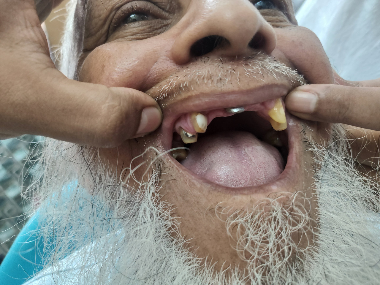 উপরের মাড়ির ১৪টি ক্রাউন লাগানোর আগে