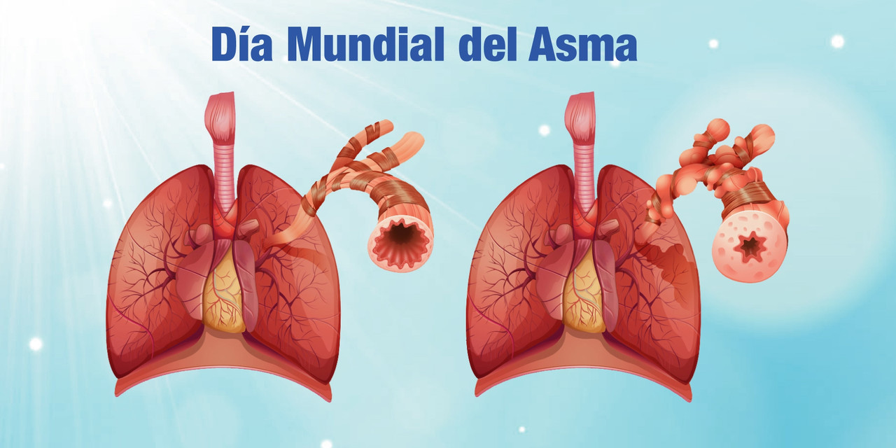 Día Mundial del Asma: Causas y consejos para combatir esta enfermedad