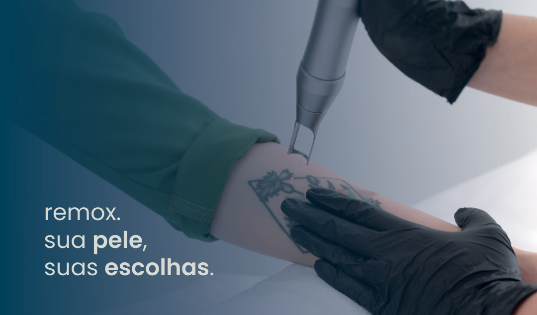 Como funciona a remoção de tatuagem a laser?