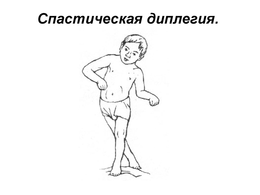 Дцп спастическая диплегия симптомы. Спастическая диплегия форма дцп. Спастическая форма дцп симптомы. Спастичечкая дифлексия. Спастическая диплегия форма дцп.