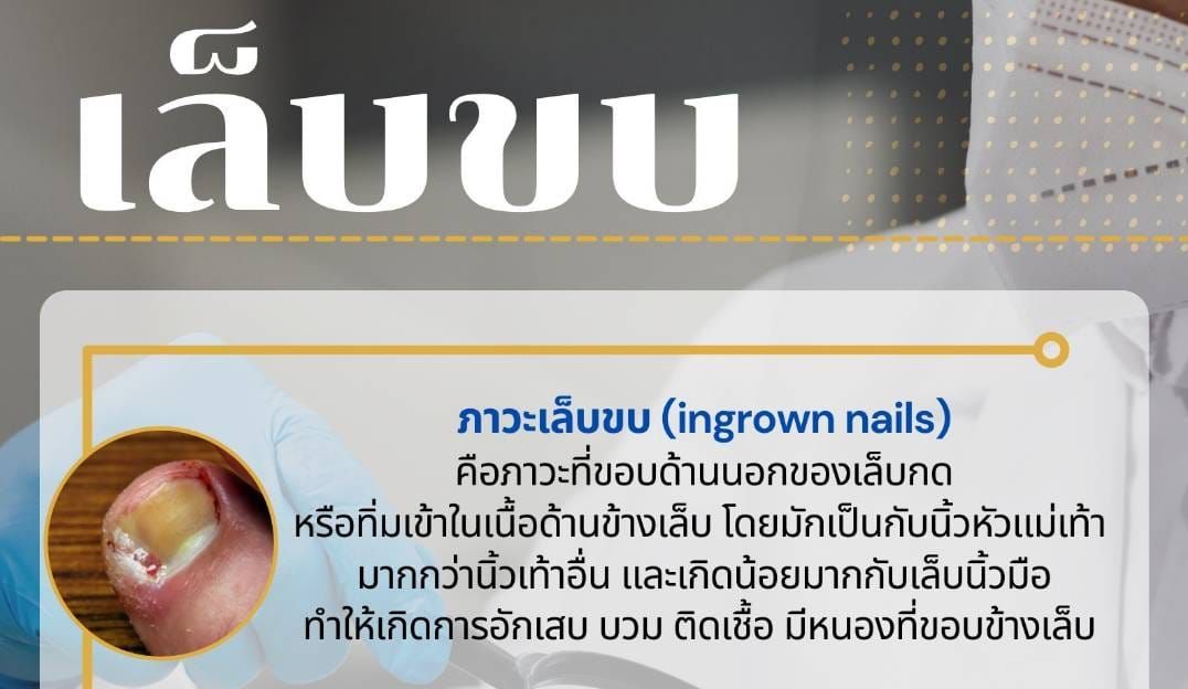 แพทย์ผิวหนังเผยสาเหตุการเกิดเล็บขบ และการดูแลรักษา