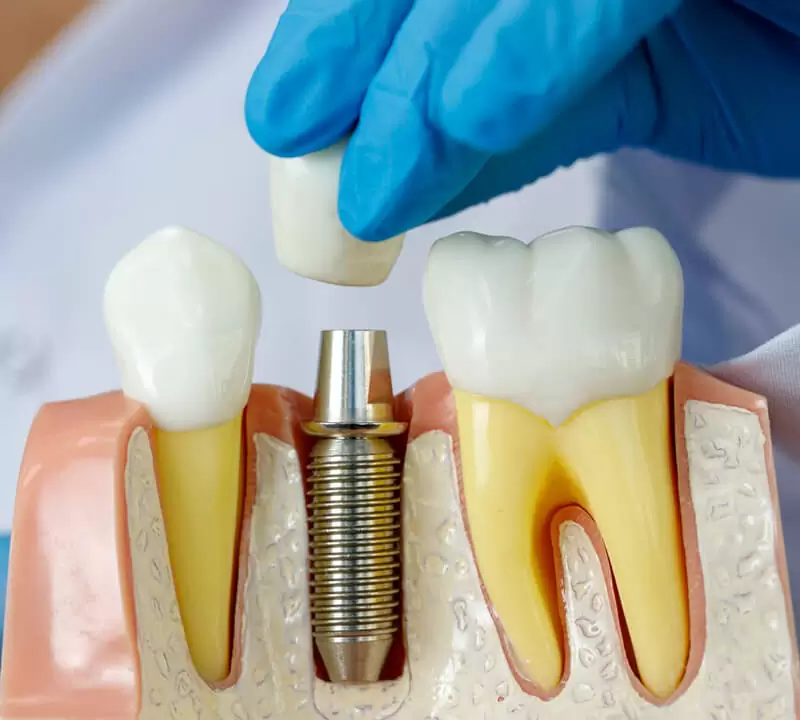 Implantes