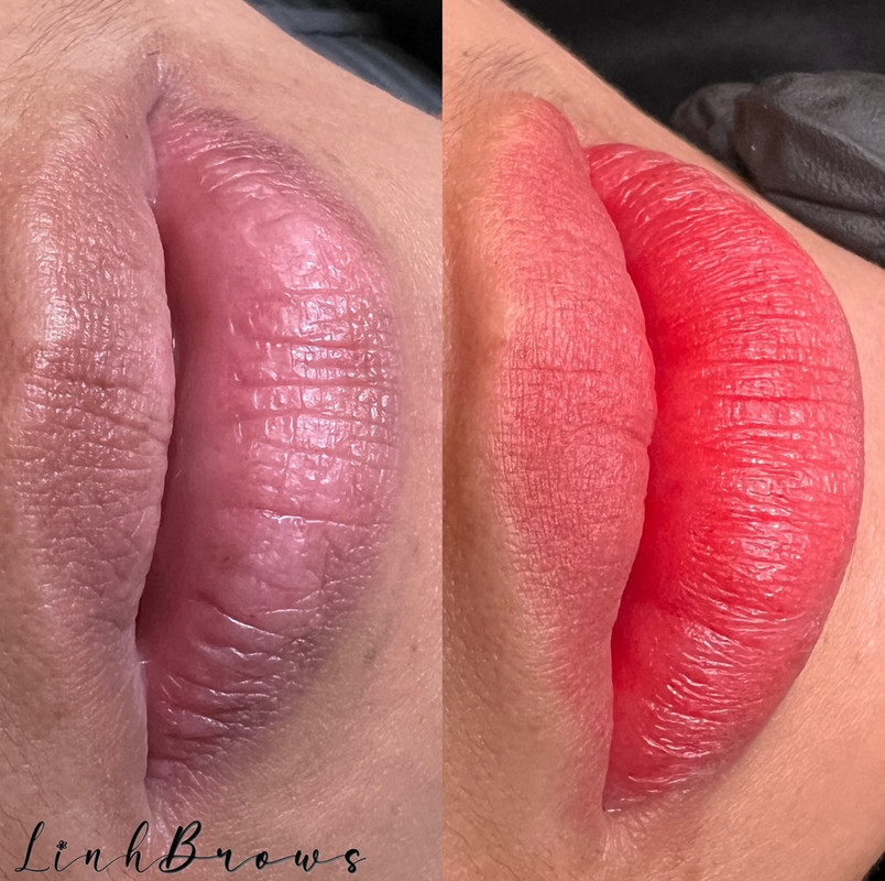 Lip Enhancement Example 1