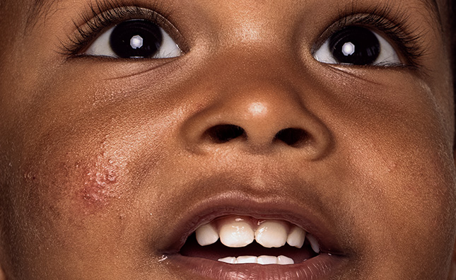 Eczema and atopic dermatitis