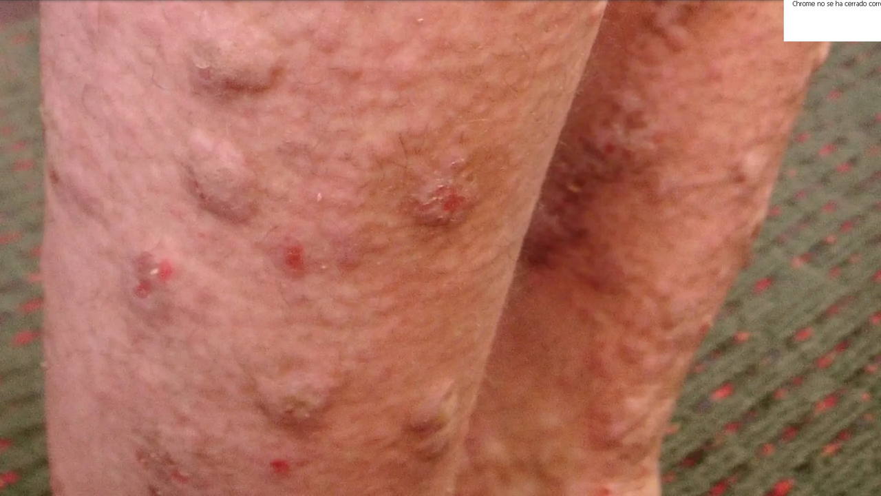 ¿Dónde salen los granos por VIH?