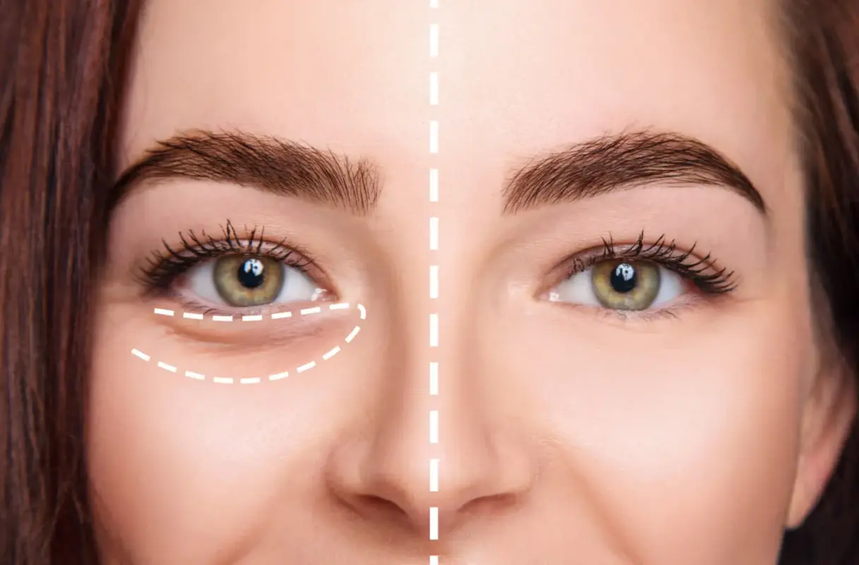 Are eye fillers safe?