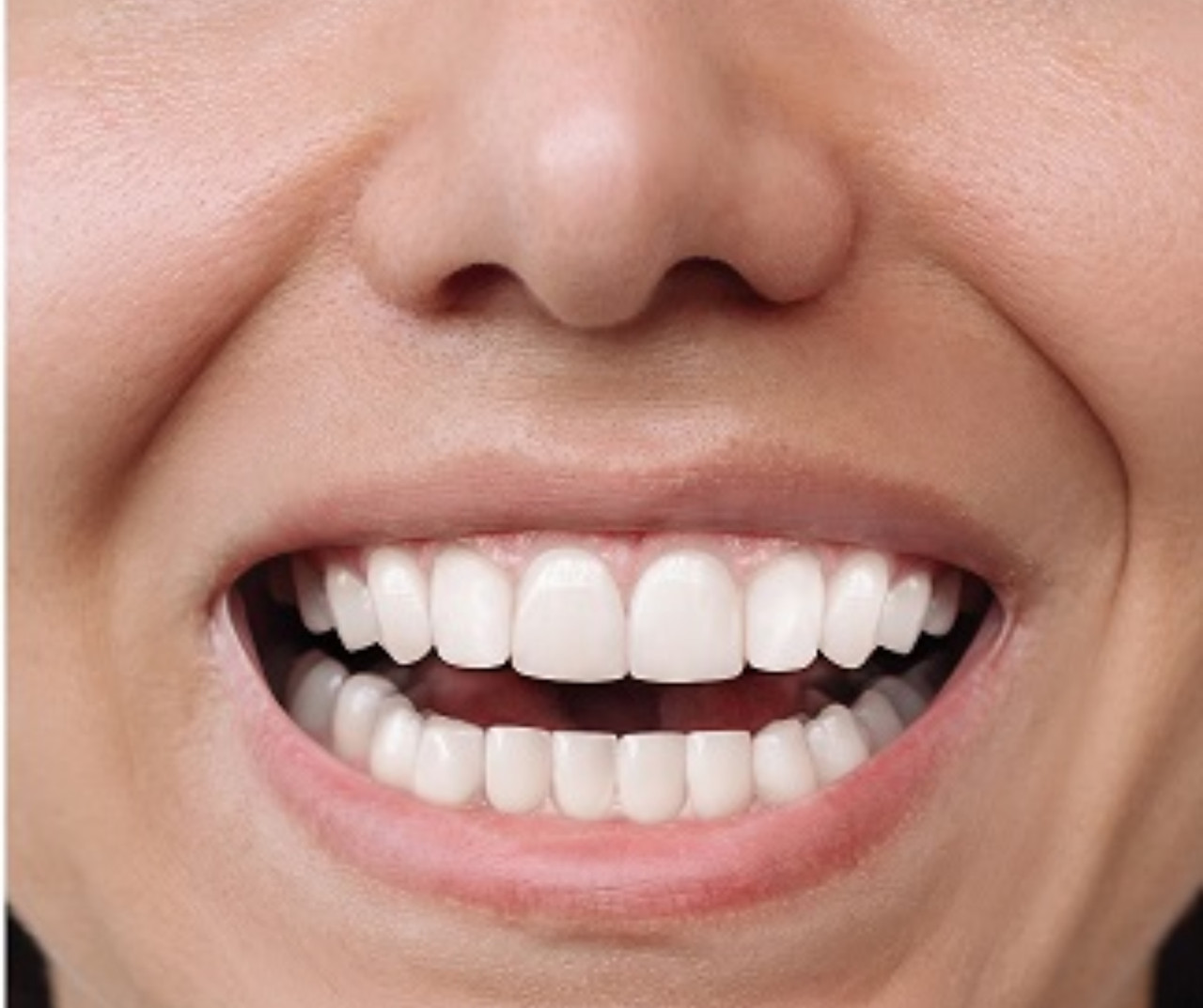 After Invisalign Treatment