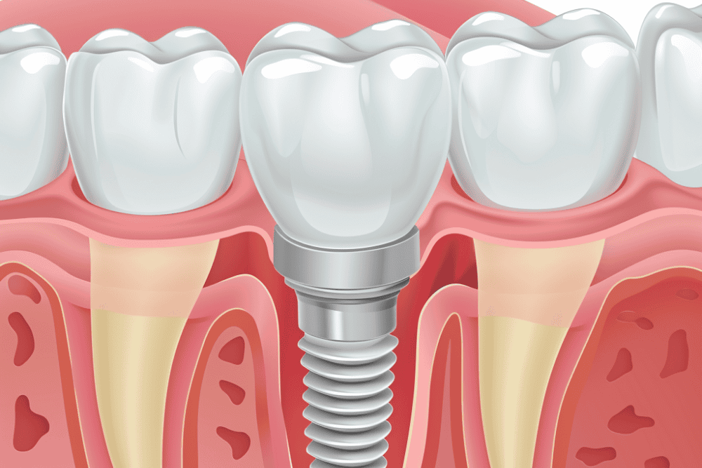 Diameter Specifications and Tensile Properties Explaining What Are Mini Dental Implants