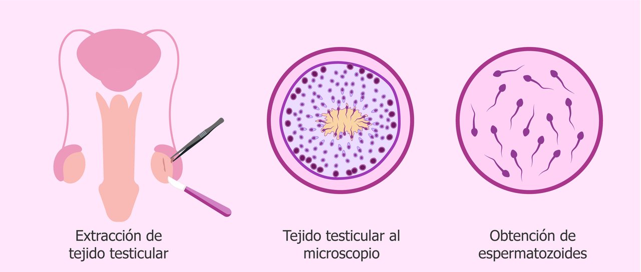 Tejido testicular masculino puede producir espermatozoides tras 20 años