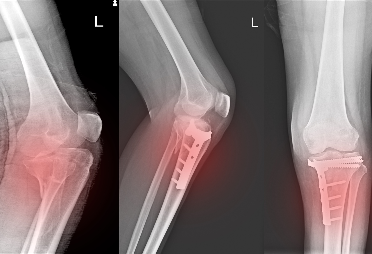 Cirugía de fracturas