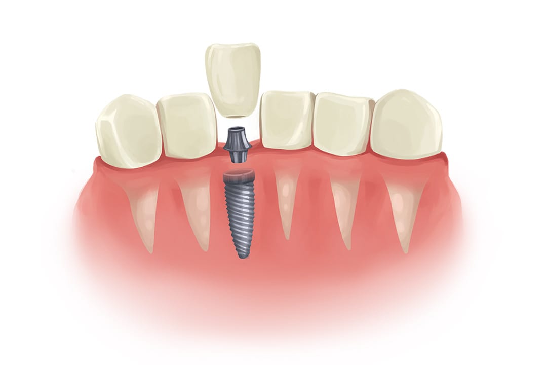 A Long-Term View on Who Should Not Get Dental Implants