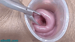 Cervix Stretching Open Wide
