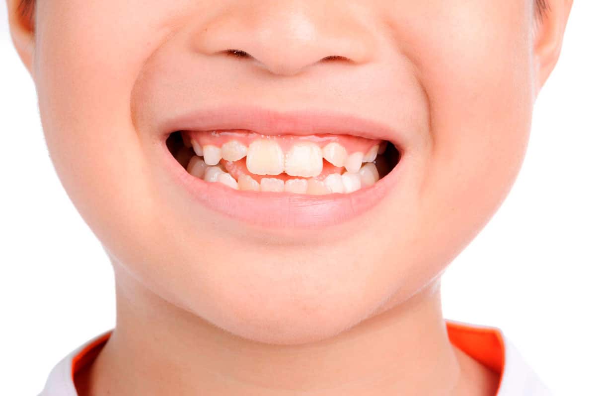 Perché i bambini soffrono di denti gessosi?