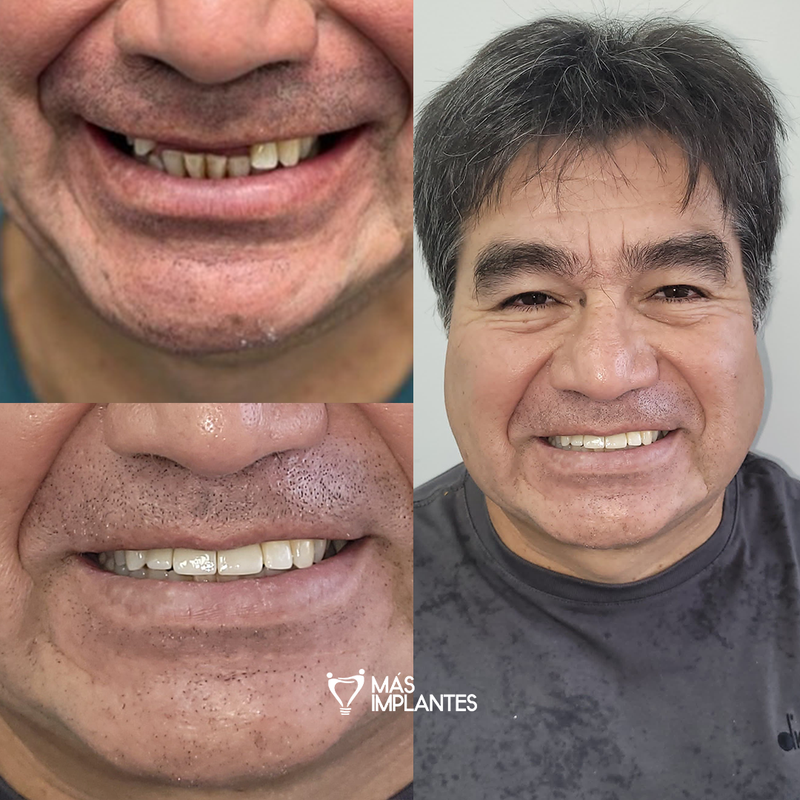 Cambio real sonrisa paciente
