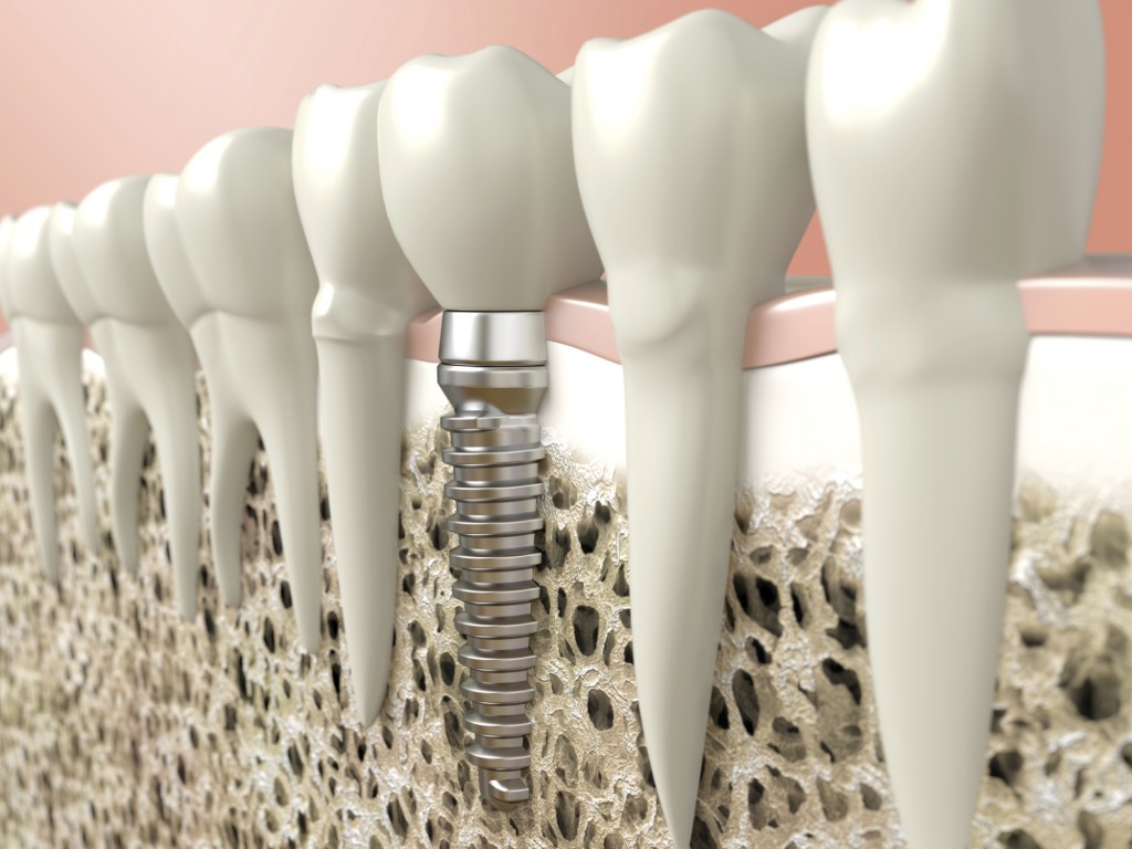 Mini Dental Implant Structure and Abutment